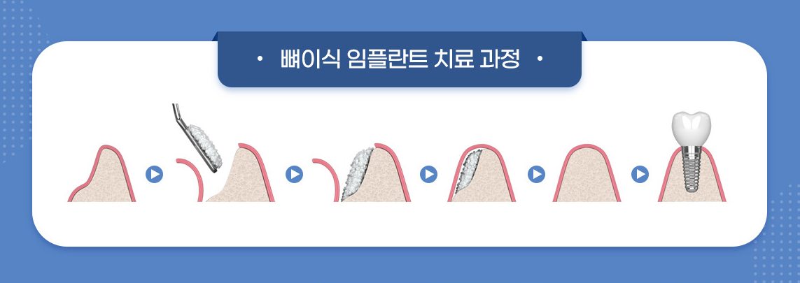 뼈이식 임플란트 치료 과정 그림