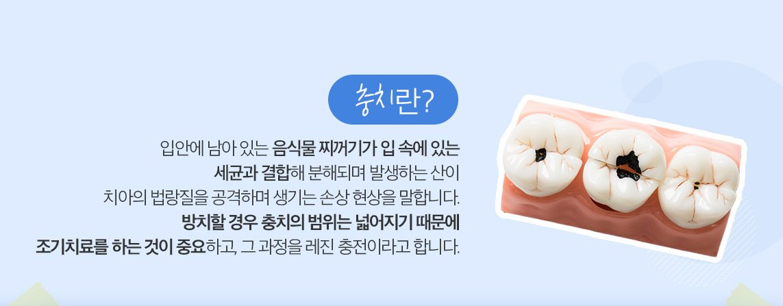 충치가 생긴 치아 모형