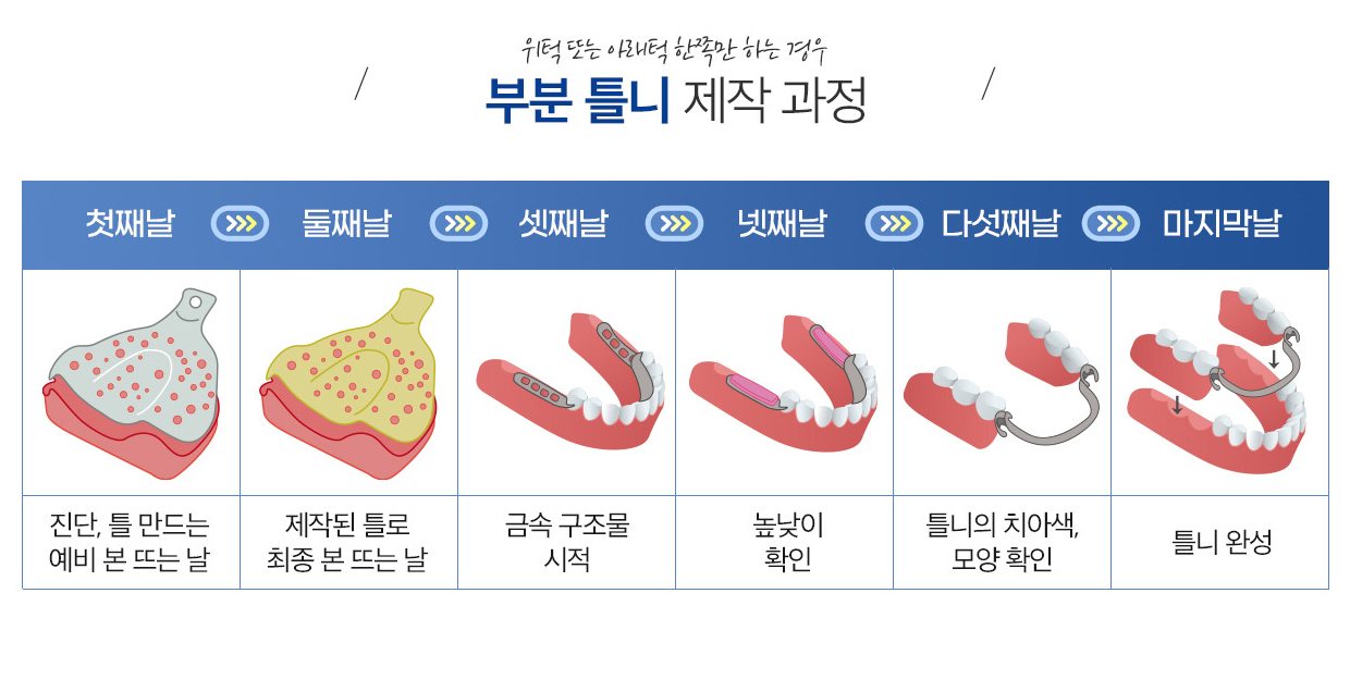 부분틀니 제작 과정 그림