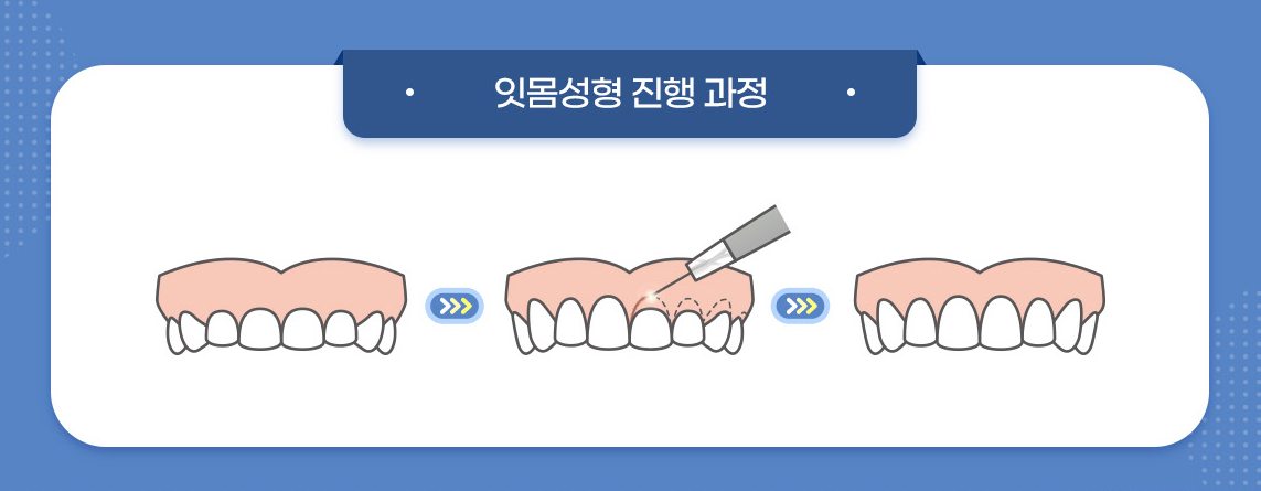 잇몸성형 진행 과정 그림