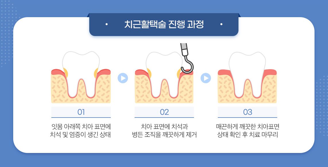 치근활택술 진행 과정 그림