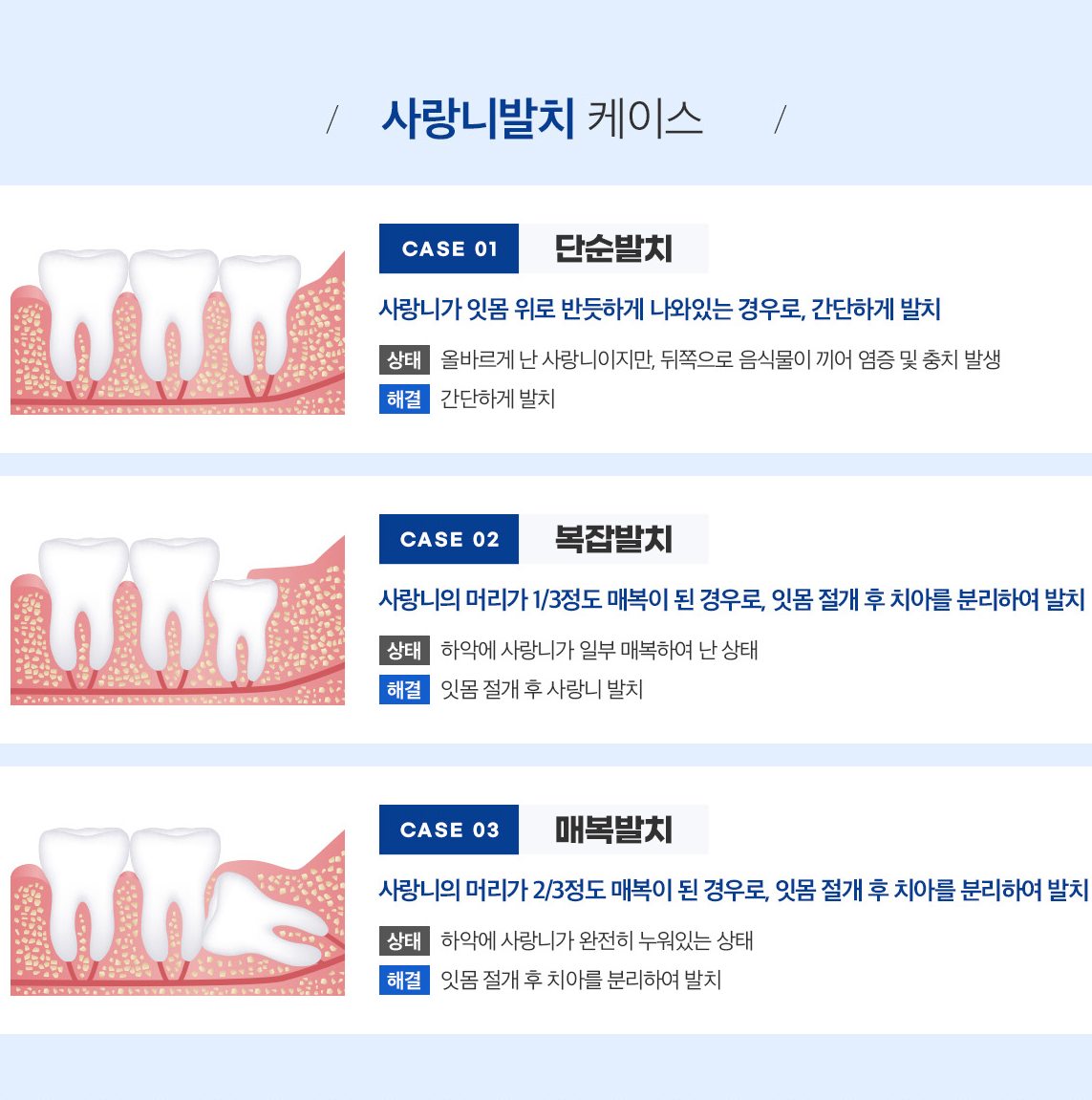 사랑니 발치 경우(단순·복잡·매복) 그림